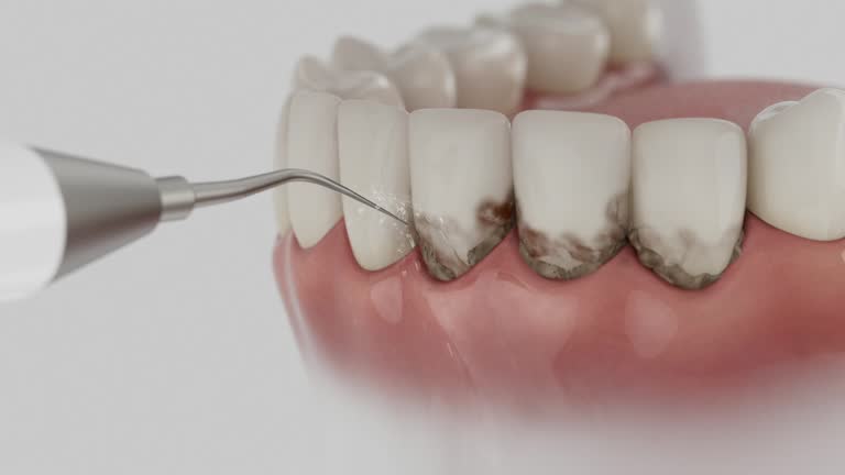 Trusted Tooth Extraction service in Parker, TX - Dentist Open Now